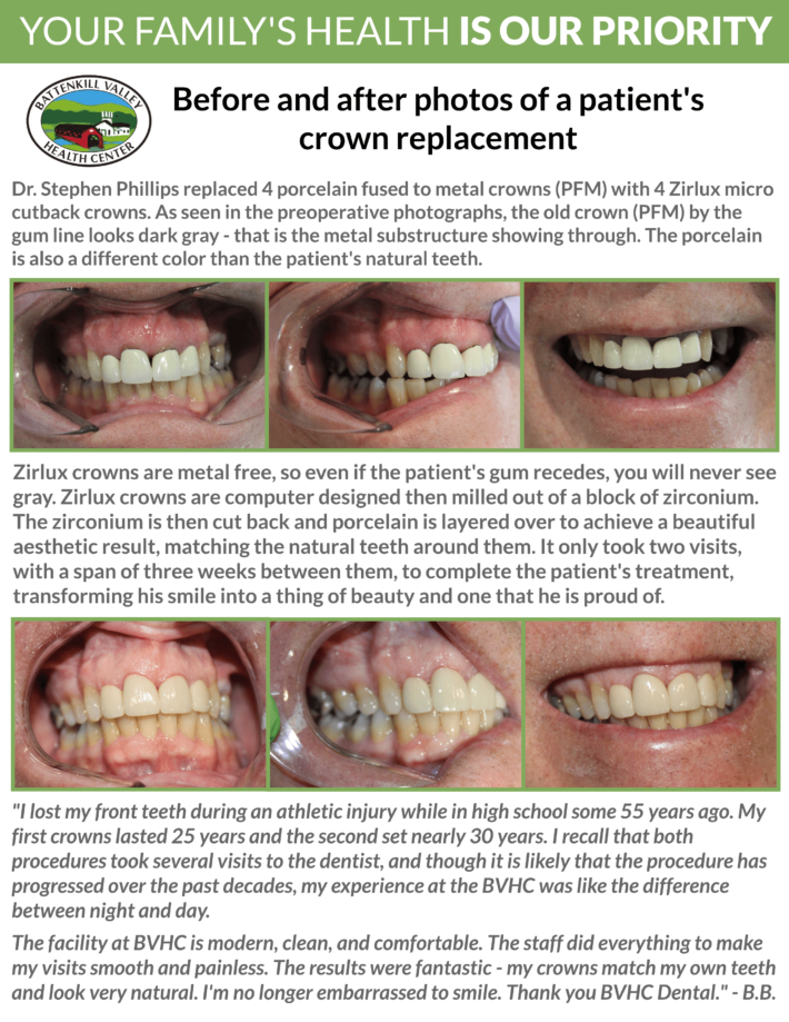 crown-replacement